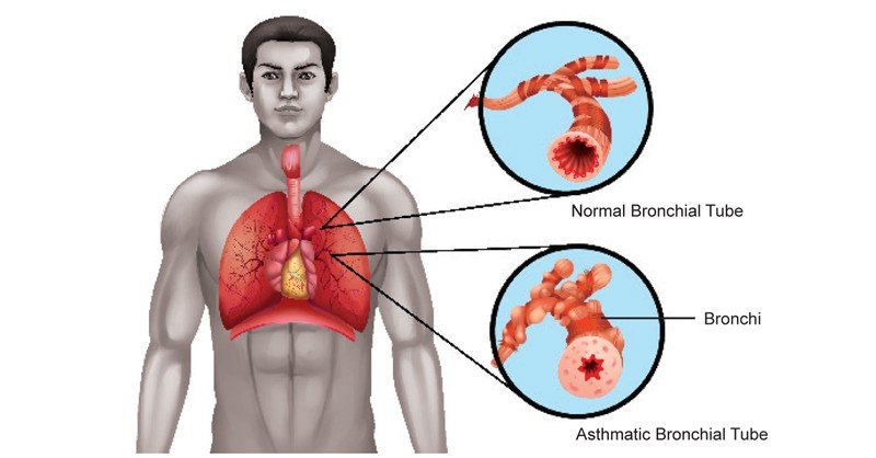 Asthma in Respiratory System - Sawan Books