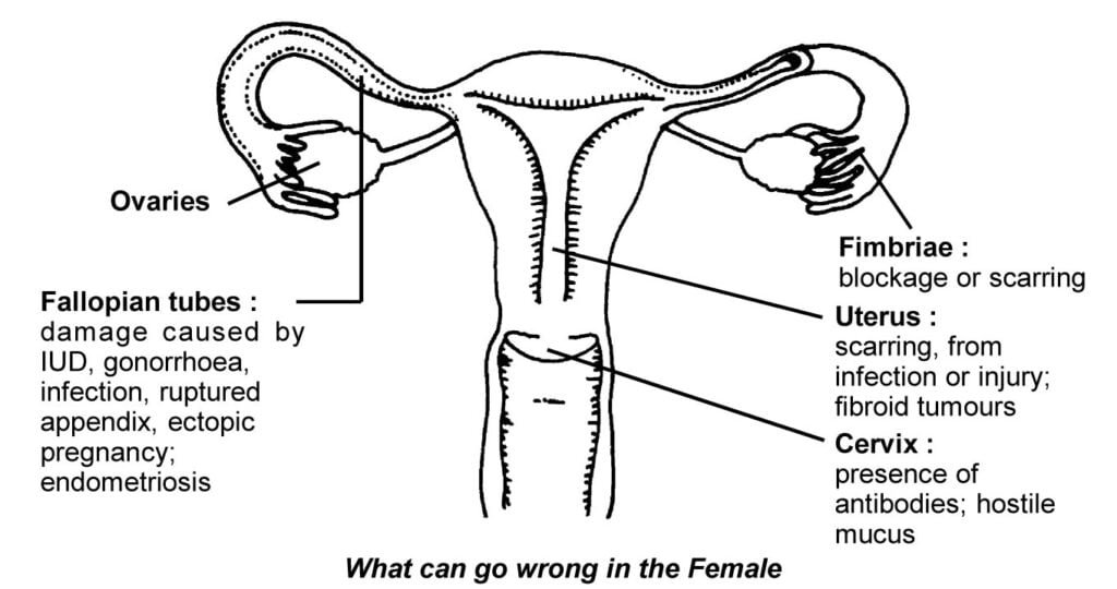 14. Infertility problem? When to start worrying - Sawan Books